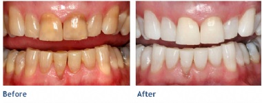 Before KöR Whitening & After KöR Whitening