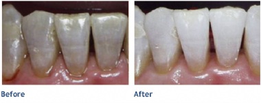 Before KöR Whitening & After KöR Whitening