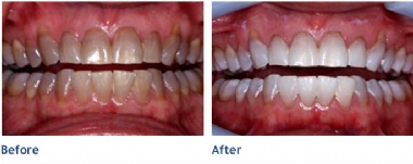 Before KöR Whitening & After KöR Whitening