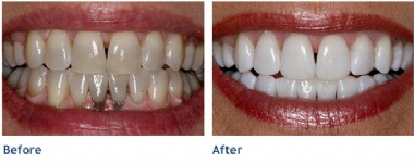 Before KöR Whitening & After KöR Whitening