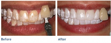Before KöR Whitening & After KöR Whitening