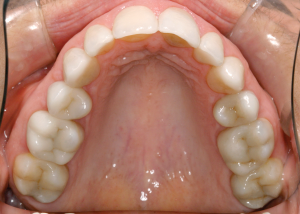 CAD/CAM Tooth Restoration