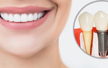 Are Dental Implants a Permanent Replacement for Missing Teeth?