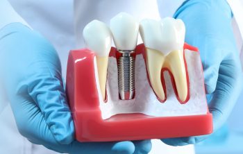 Can Molars and Premolars be Replaced with Dental Implants?