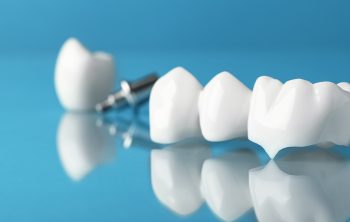 Who Is A Candidate For CEREC Crowns?