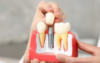 How Long Does the Pain Last After an Implant Surgery?
