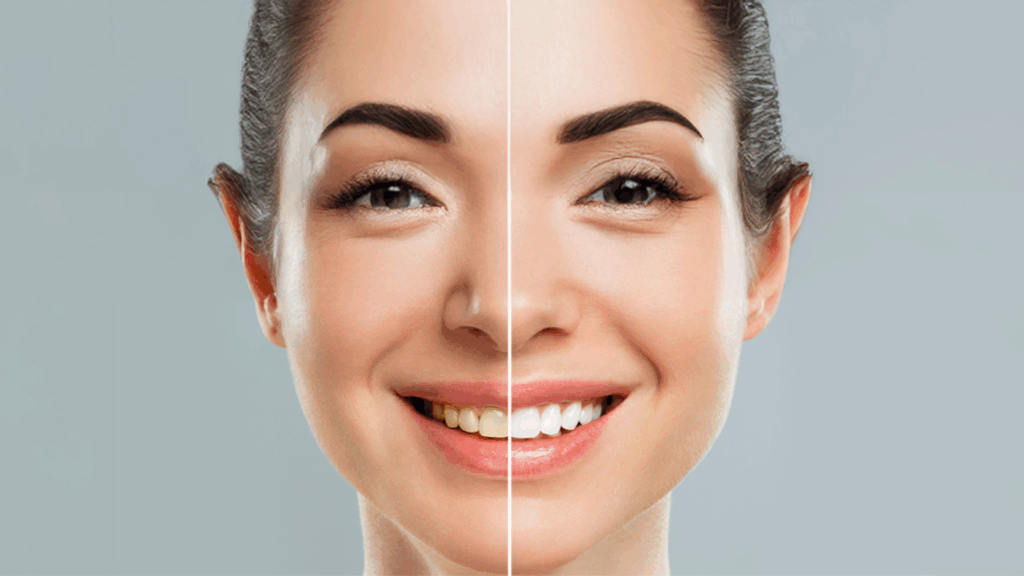 Professional Teeth Whitening in Laguna Beach: What Stains It Can & Can’t Fix