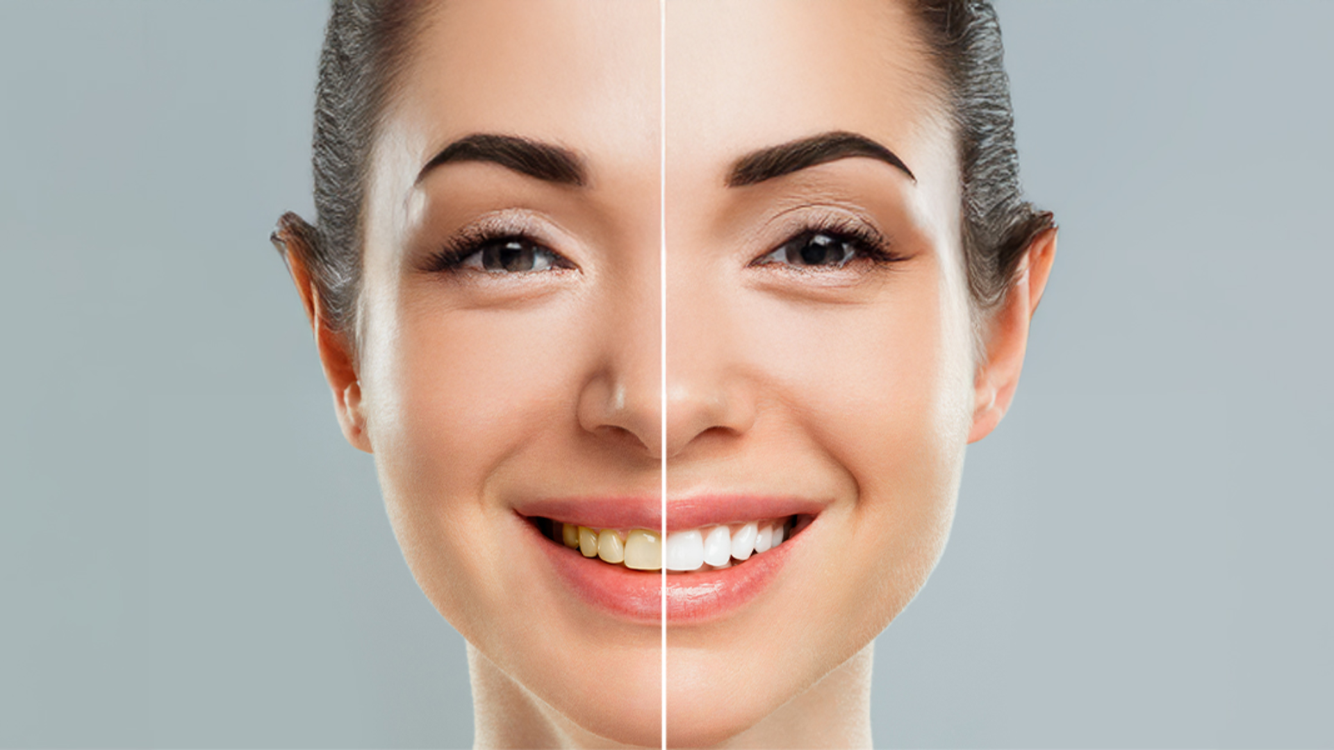 Professional Teeth Whitening in Laguna Beach: What Stains It Can & Can’t Fix