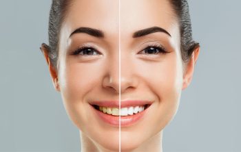 Can Teeth Whitening Effectively Remove All Types of Stains?